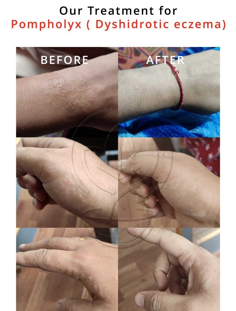 Our Treatment for Pompholyx or Dyshidrotic eczema (Blister)